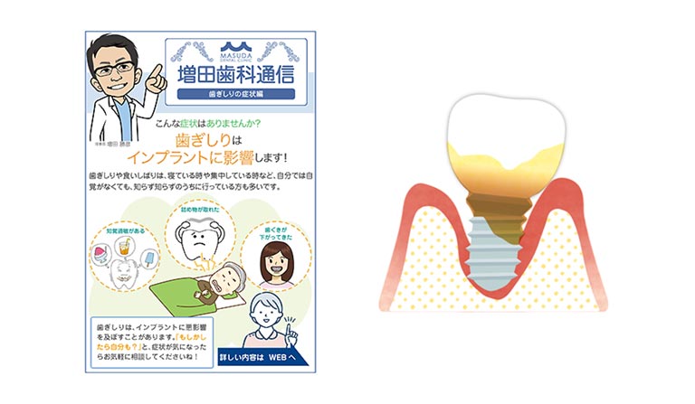 インプラントが失敗する理由は歯ぎしりに…