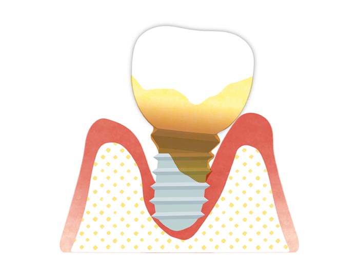 インプラントと歯ぎしりの関係